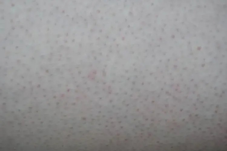 什么是鸡皮肤图片