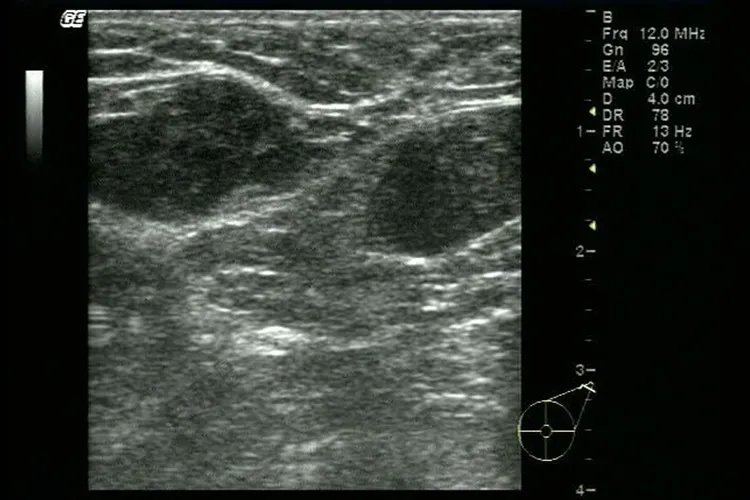 乳腺癌酒窝征清晰图片