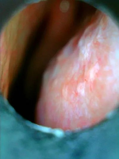 慢性鼻炎症状表现?