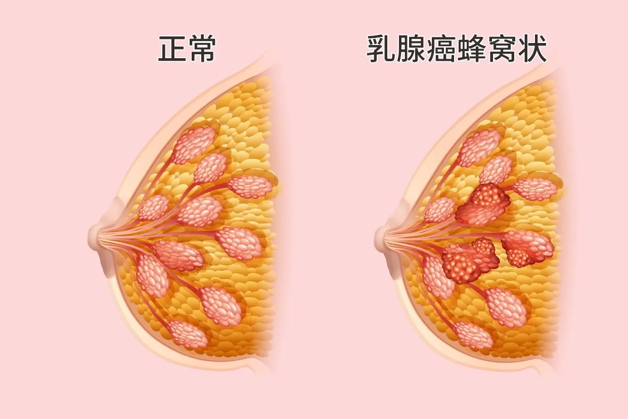 乳腺癌蜂窝状图片