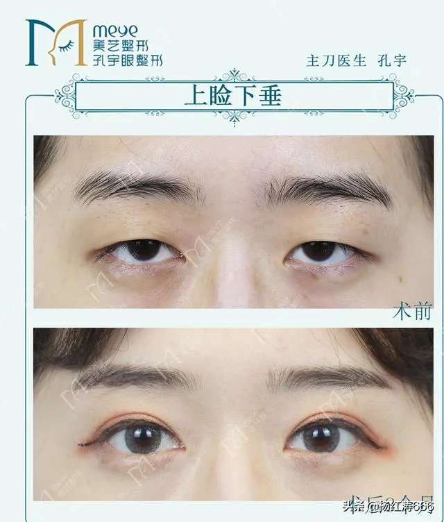 割双眼皮到底好不好？