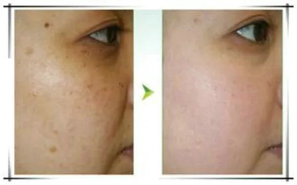 激光点痣多少钱？