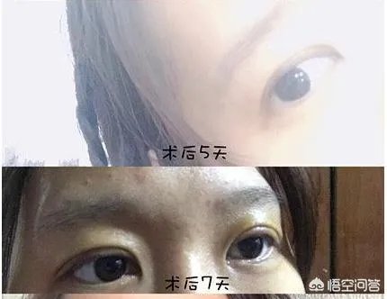 割双眼皮到底好不好？