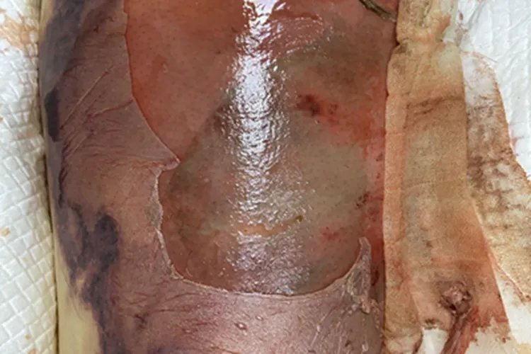 皮肤炭疽脱皮图片