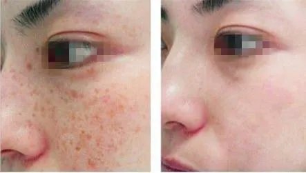 光子嫩肤可以彻底祛痘吗