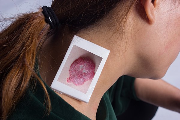 多发性脂肪瘤怎么控制