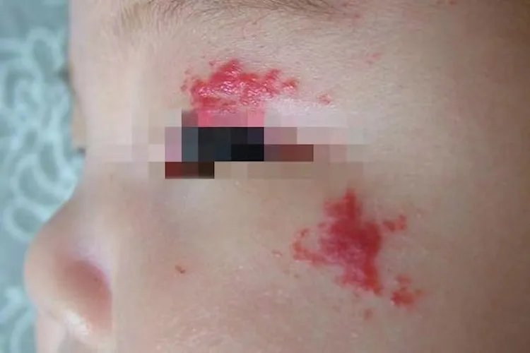 新生儿胎记怎么判断图片