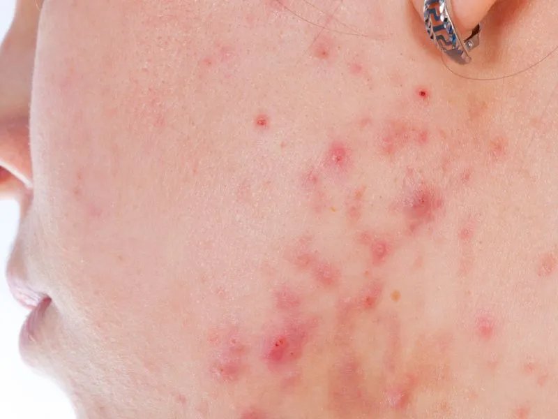 去痘痘的方法有哪些