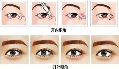 开眼角手术前后的注意事项是哪些？