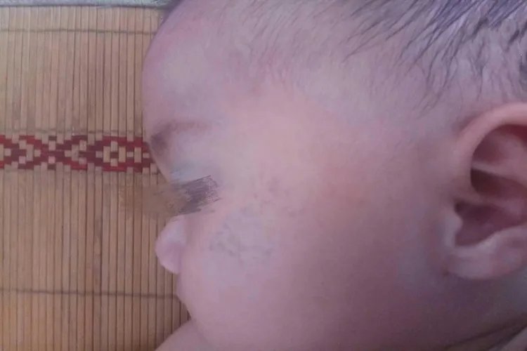 新生儿胎记怎么判断图片