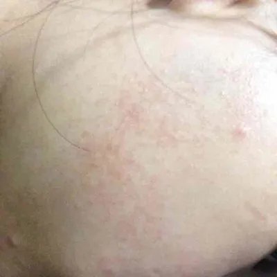 扁平疣最佳治疗方法是什么？