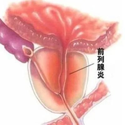 前列腺稍大怎么回事?