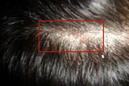 头皮汗癣的图片