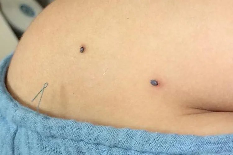 如何鉴别被蜱虫咬了皮肤小结节图片