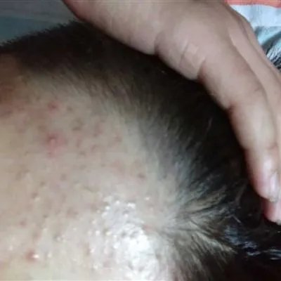 额头长痘怎么治疗