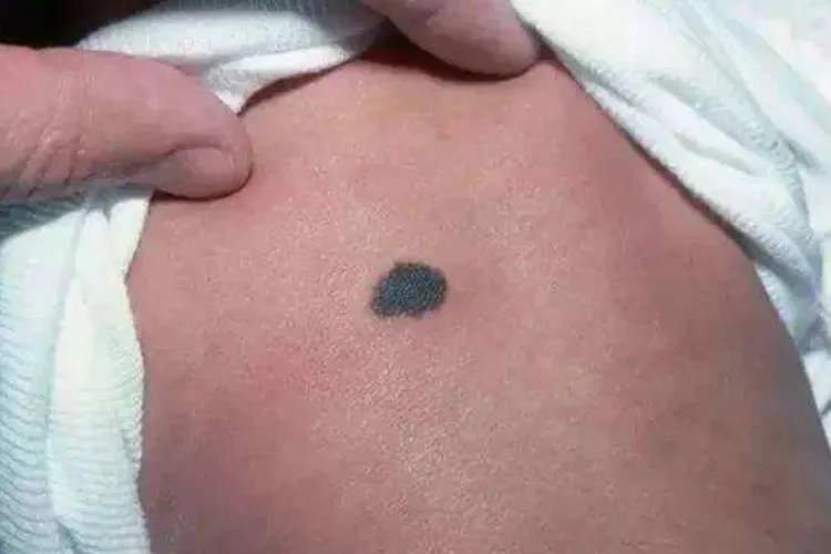 新生儿胎记怎么判断图片