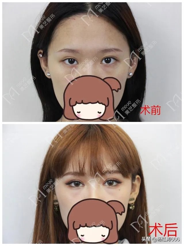 割双眼皮到底好不好？