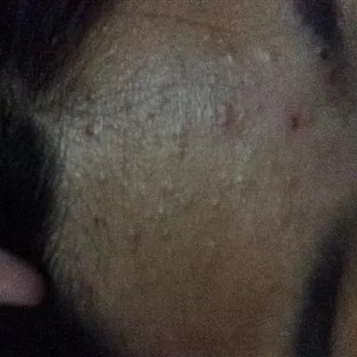 额头长痘怎么治疗