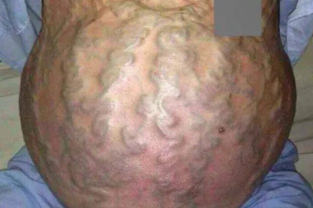 海蛇头样静脉曲张照片