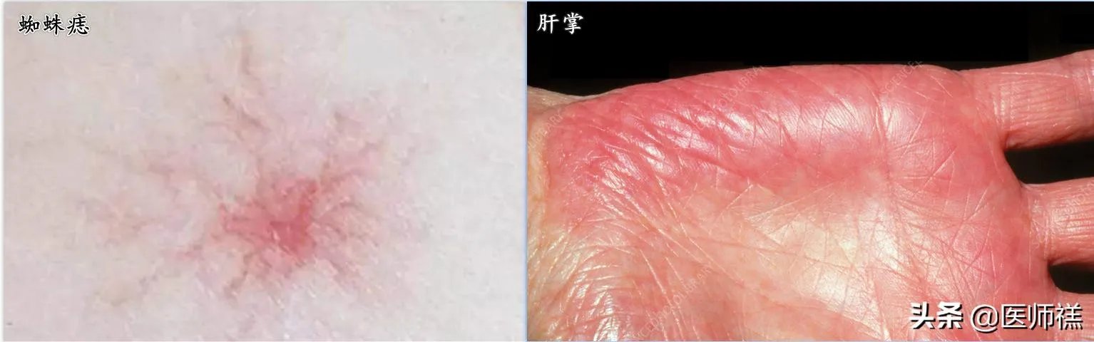 肝硬化前兆有哪些症状？