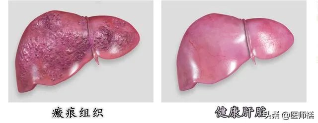肝硬化前兆有哪些症状？