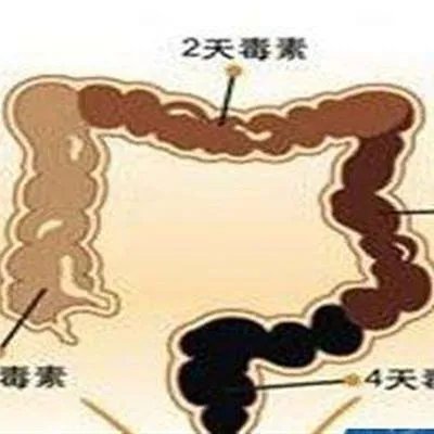 肠癌晚期怎么治疗