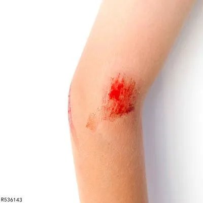 伤口痒是什么原因引起的