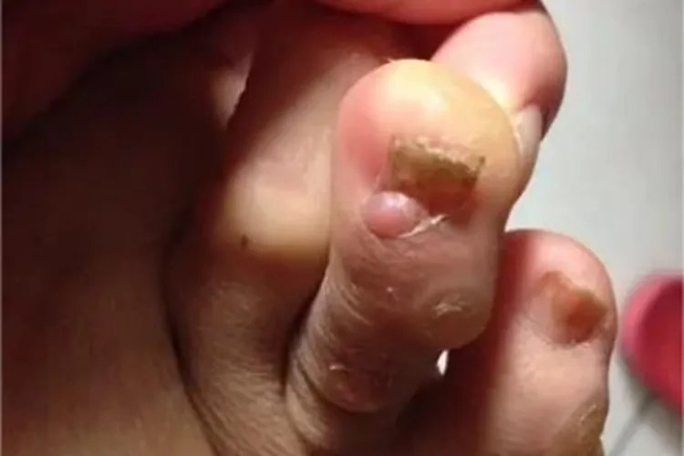 结节性硬化症肉球图片