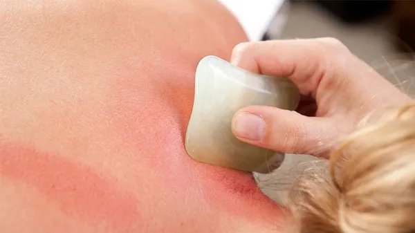 痤疮的中医治疗方法有哪些