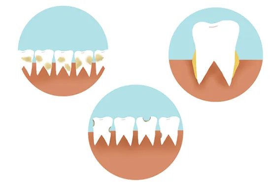 牙龈肿痛有脓包怎么办