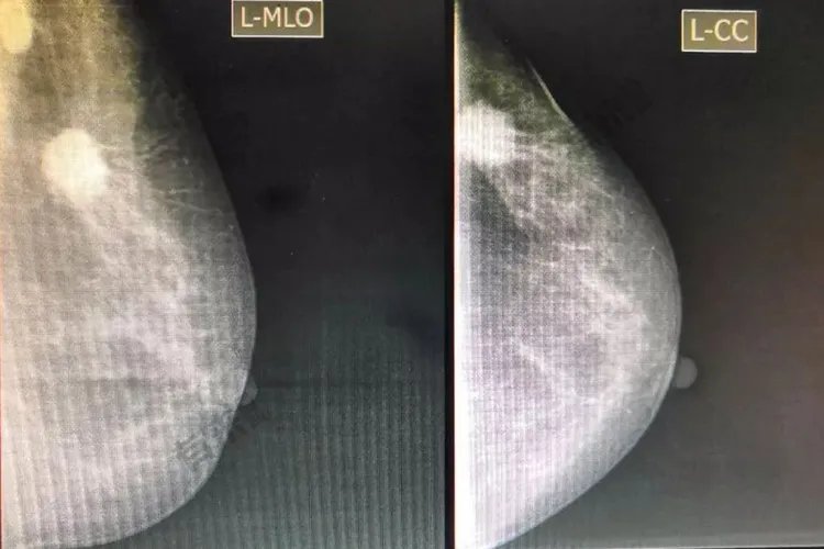 乳腺癌酒窝征清晰图片