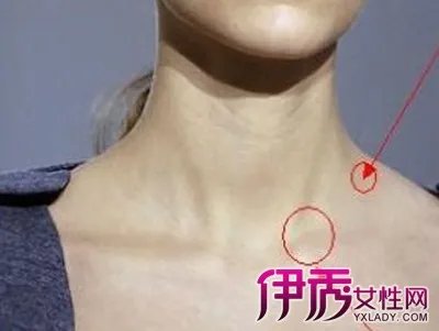 颈部淋巴癌早期图片