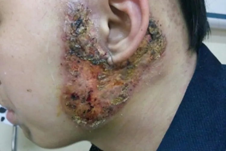 坏疽性脓皮病症状图片