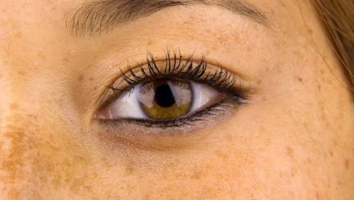 激光祛斑效果如何