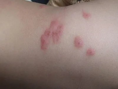 蚤病胳膊大红疙瘩图片