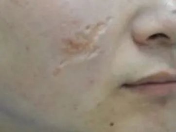 凹陷疤痕怎么办