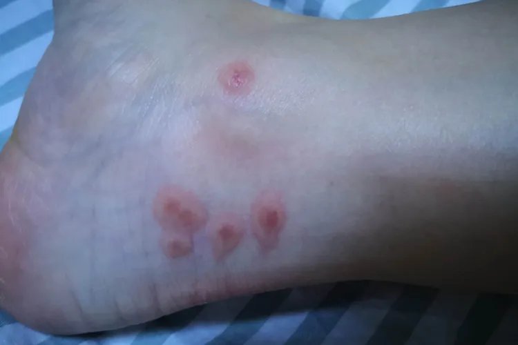 如何鉴别被蜱虫咬了皮肤小结节图片
