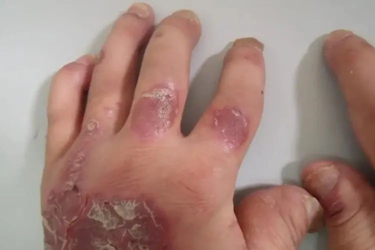 银屑病的症状表现图片