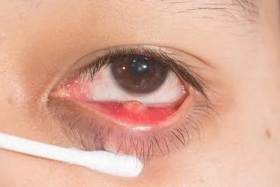 眼部脂肪粒会自己消失吗 揭秘消除眼部脂肪粒小妙招