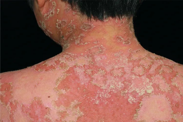 银屑病的症状表现图片