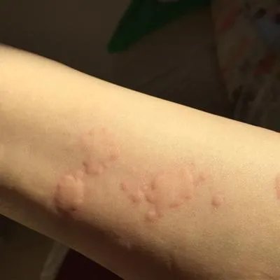 胆碱荨麻疹怎么治疗