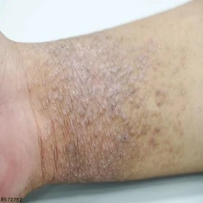 治疗牛皮癣的特效药有哪些