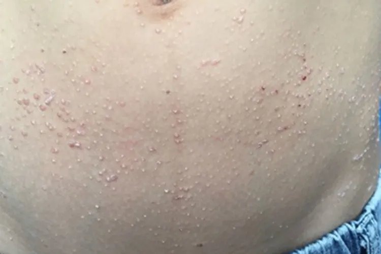 毛发红糠疹腹部症状图片