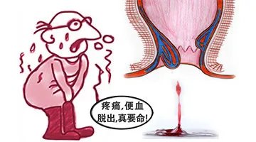 混合痣疮的症状