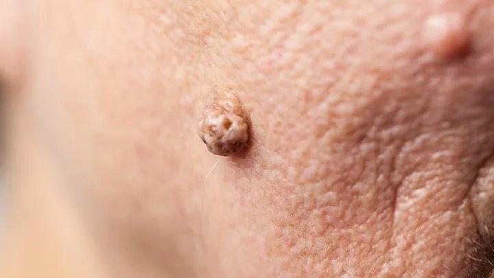 脸上黄褐斑怎么去