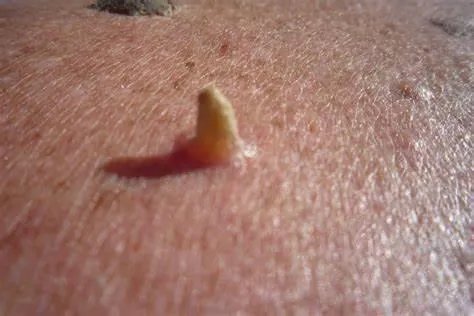 肉粒长什么样子图片