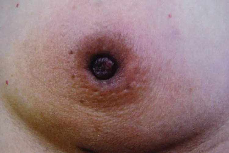 乳腺癌酒窝征清晰图片