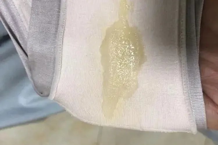 宫颈癌内裤分泌物图片