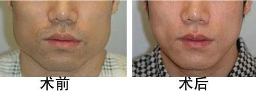 男士整容需要多少钱