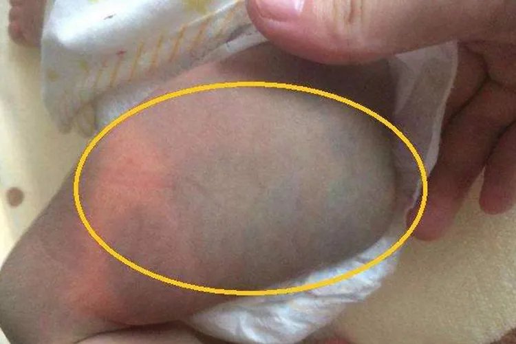 新生儿胎记怎么判断图片